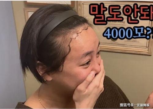 韩国明星植发,重拾青春风采的秘密